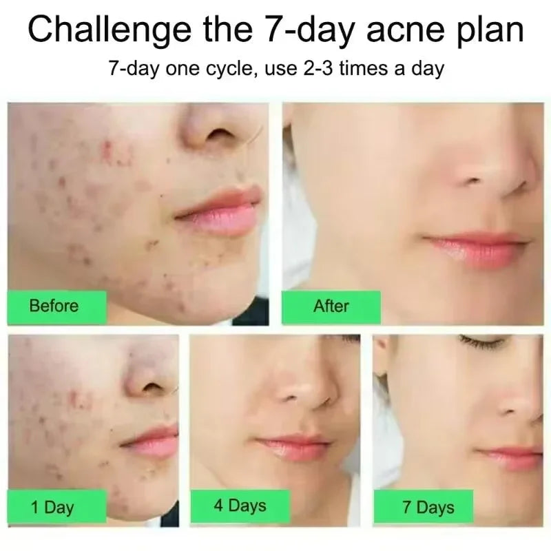 Salicylic Acid Acne Treatment Face Cream Repair Pimple Spots