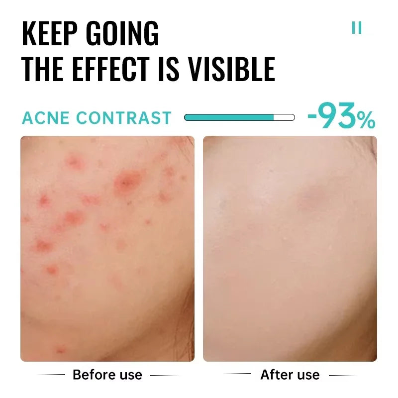 Salicylic Acid Acne Treatment Face Cream Repair Pimple Spots