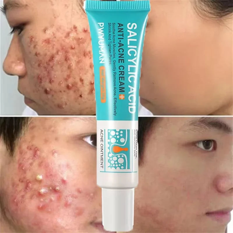 Salicylic Acid Acne Treatment Face Cream Repair Pimple Spots