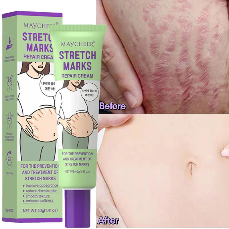 Stretch Marks Repair Cream