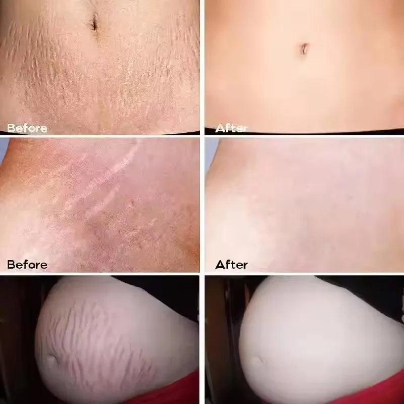 Stretch Marks Repair Cream
